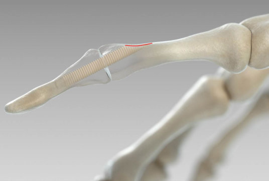 Screws_Bones_a5755_0.jpg Screws_Bones_a5755_0.jpg